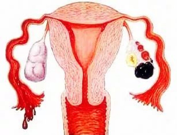 试管助孕婴儿对女性的危害-子宫肌瘤如何开始北京市试管周期+